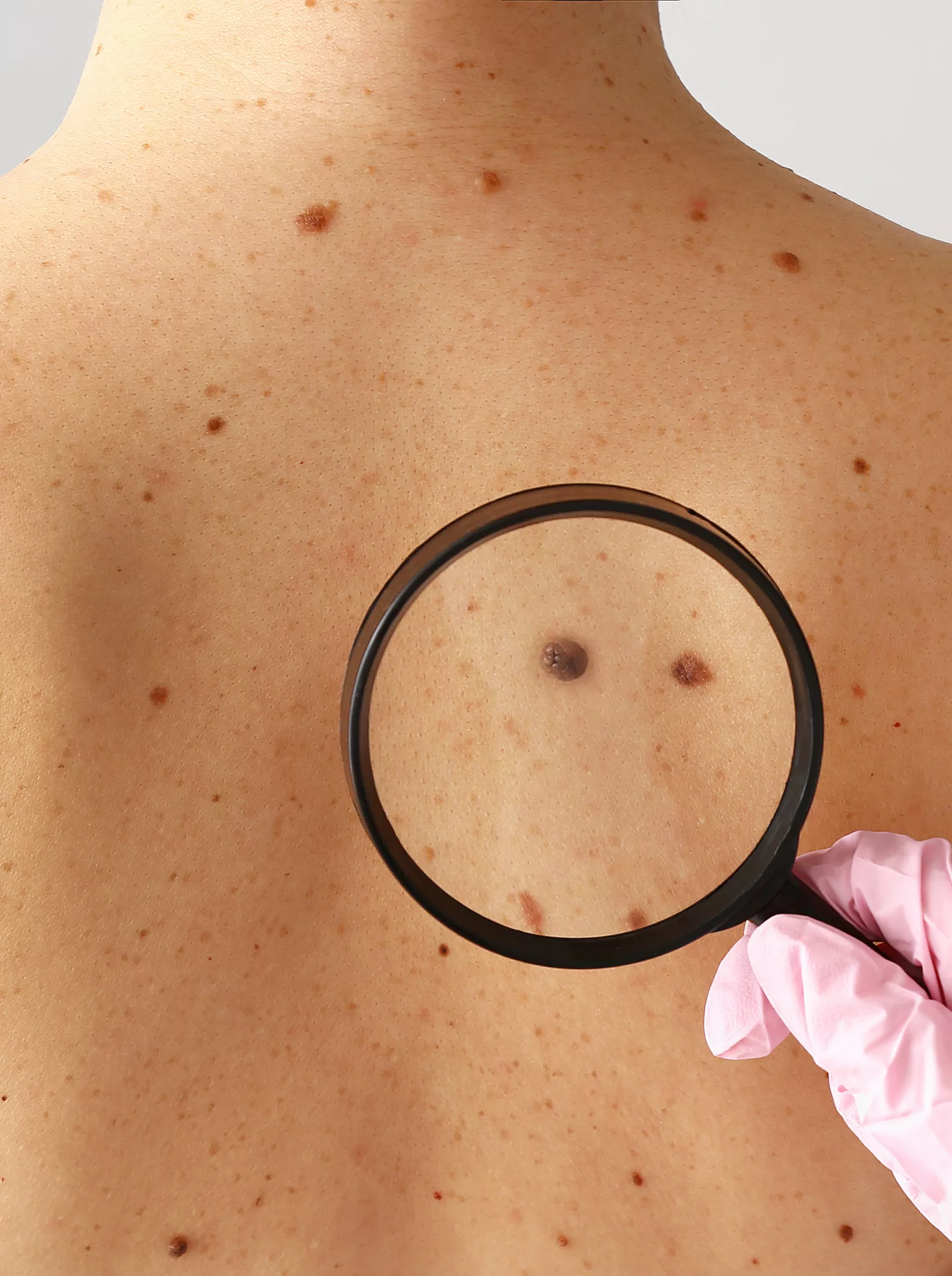 Untersuchung eines Leberflecks